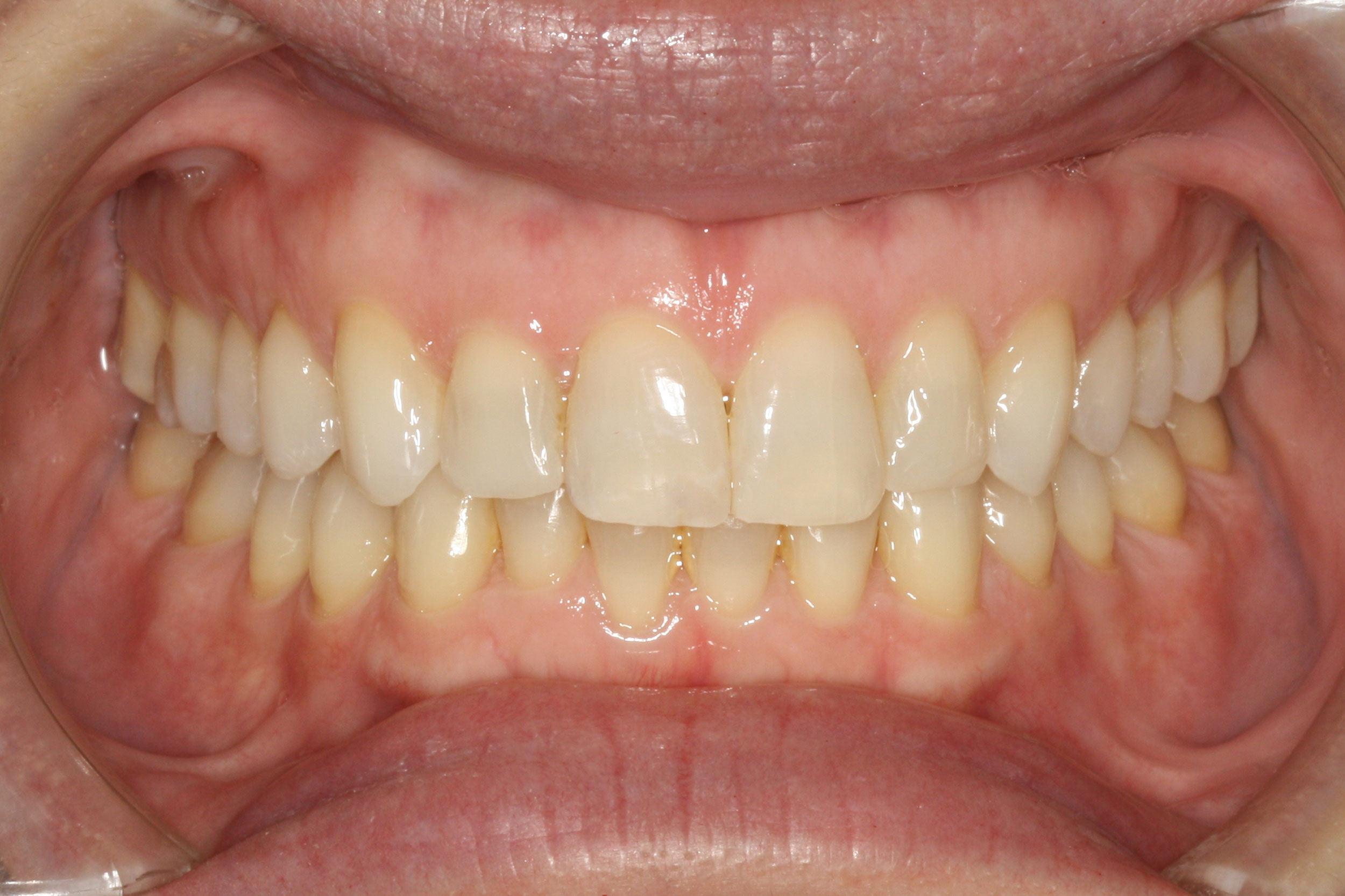 Θεραπεία 10 μηνών με αόρατους νάρθηκες Invisalign