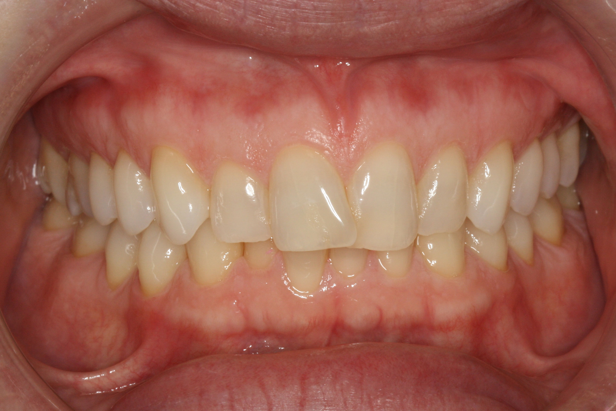 Θεραπεία 10 μηνών με αόρατους νάρθηκες Invisalign