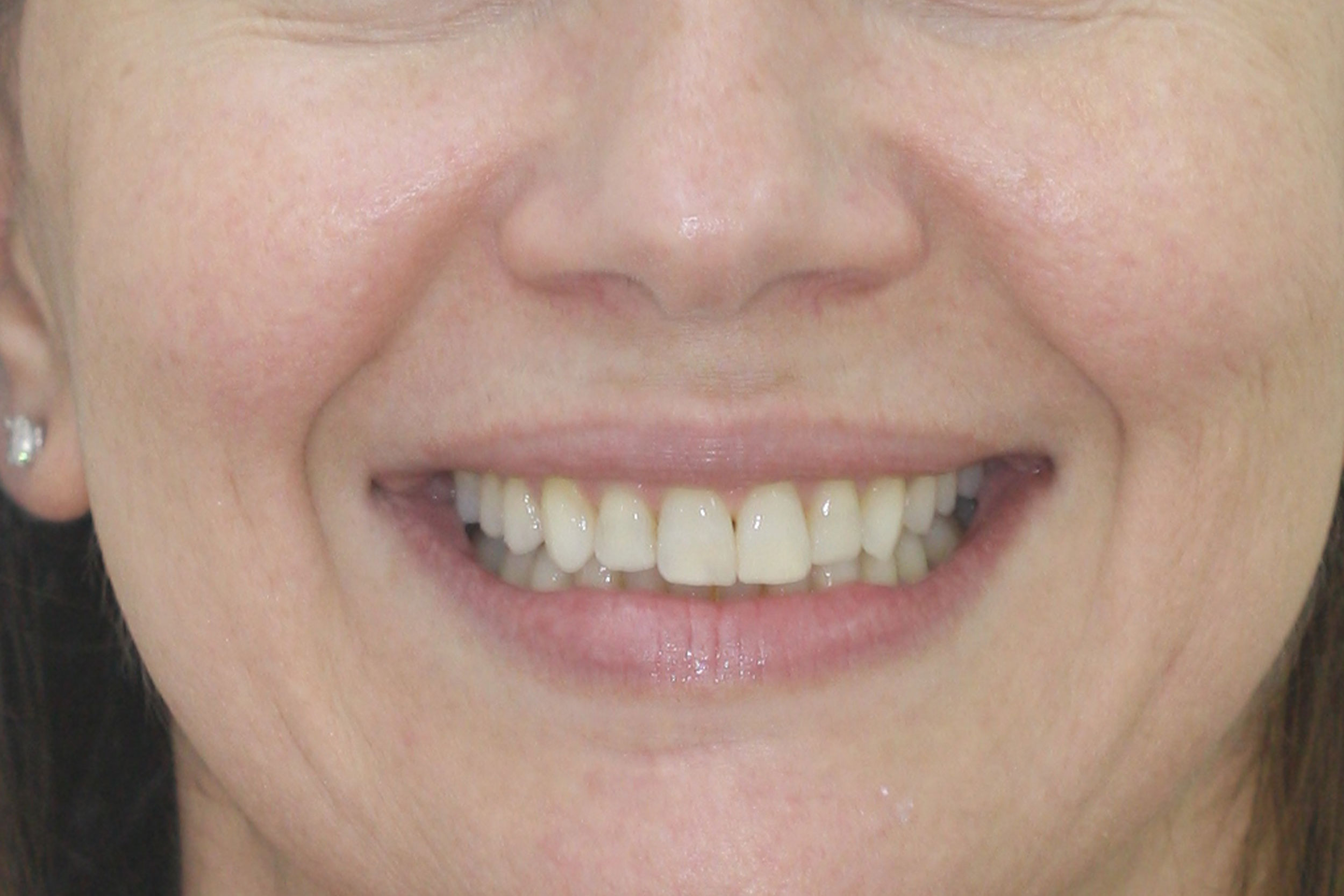 Θεραπεία 10 μηνών με αόρατους νάρθηκες Invisalign