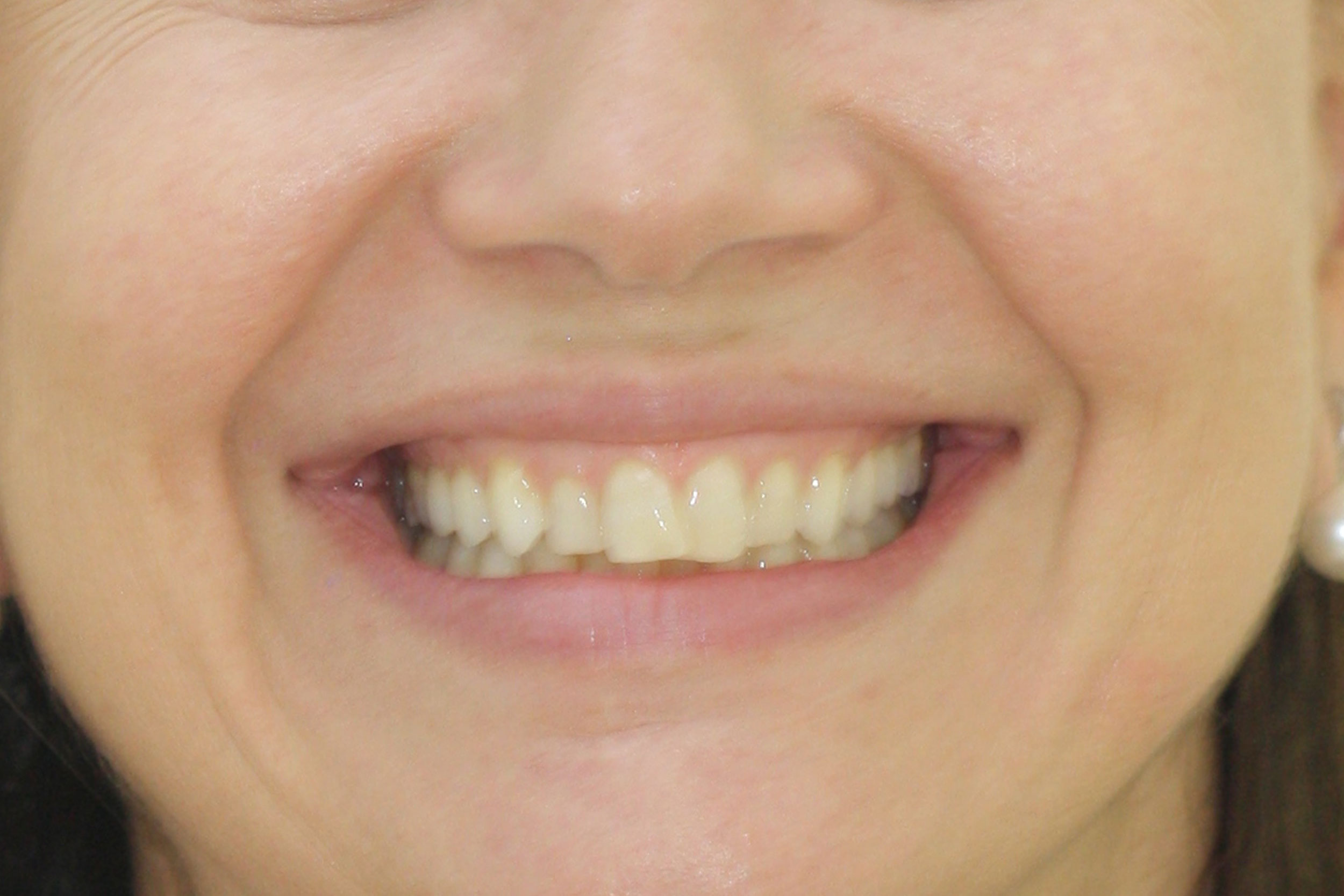 Θεραπεία 10 μηνών με αόρατους νάρθηκες Invisalign